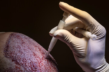 Hair transplantation. Macrophotography of a hair bulb transplanted into a hairless area. Baldness...