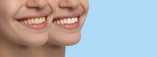 Collage with photos of woman before and after tooth whitening on light blue background, closeup....