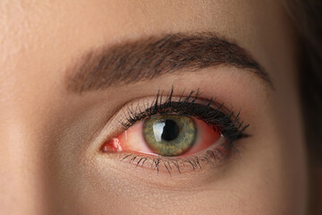 Fototapeta premium Woman suffering from conjunctivitis, closeup of red eye