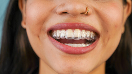 Young Asian Indian woman holding removable invisible aligner, also known as invisalign or  clear...