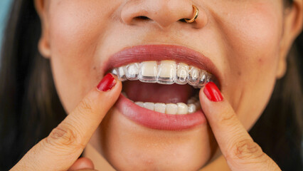Young Asian Indian woman holding removable invisible aligner, also known as invisalign or  clear aligner