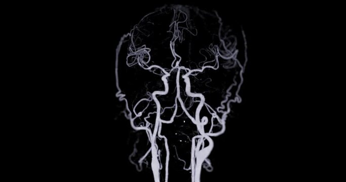 CTA brain or Computed tomography angiography of the brain 3D rendering.