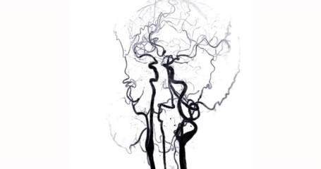 CTA brain or Computed tomography angiography of the brain 3D rendering. - Powered by Adobe