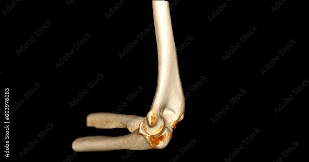 Poster ct scan of elbow joint 3d rendering image turn around on the screen .
