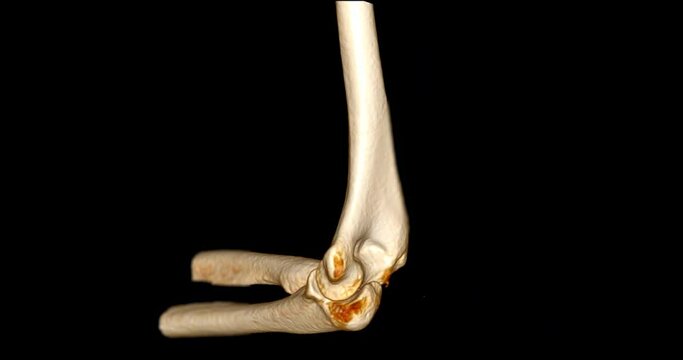 CT scan of Elbow joint 3D rendering image turn around on the screen .