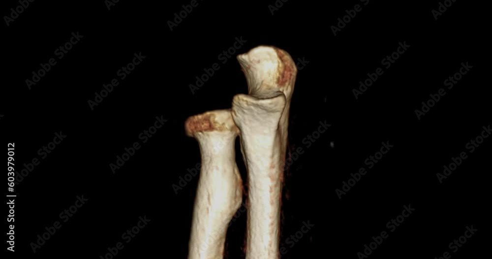 Poster ct scan of elbow joint 3d rendering image after subtraction humerus bone turn around on the screen .