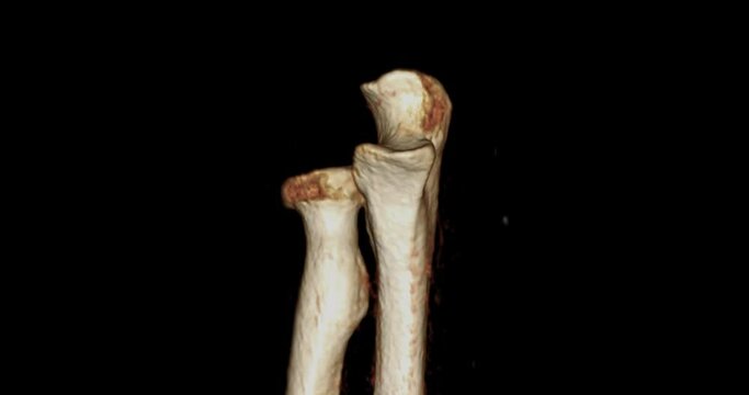 CT scan of Elbow joint 3D rendering image after subtraction humerus bone turn around on the screen .