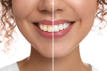 Photo of woman divided in halves before and after tooth whitening on white background, closeup. Collage design