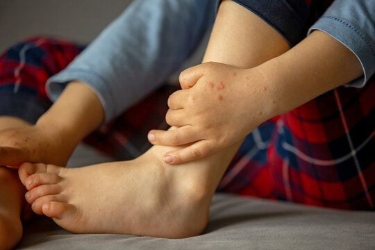 Child with skin rash, roseola. Hand-foot-and-mouth disease. Enterovirus Leg arm mouth Rash on  child. Cocksackie virus