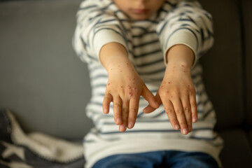 Child with skin rash, roseola. Hand-foot-and-mouth disease. Enterovirus Leg arm mouth Rash on ...