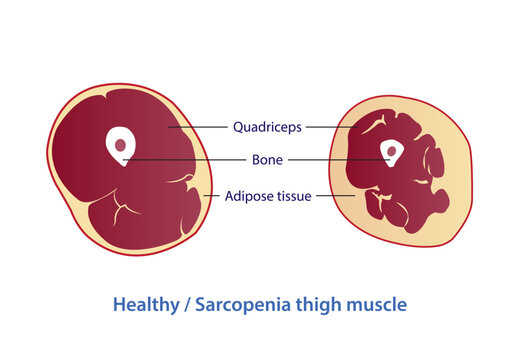 Infographic of healthy and sarcopenia thigh muscle vector illustration isolated on white background. Cross section of strength and losing muscle mass. Anatomy and health care concept illustration.