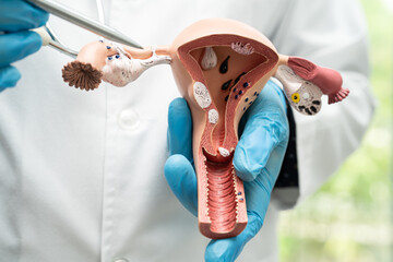 Uterus, doctor holding anatomy model for study diagnosis and treatment in hospital.