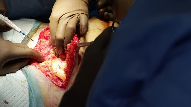 abdominoplasty correction of the abdomen with the help of surgery