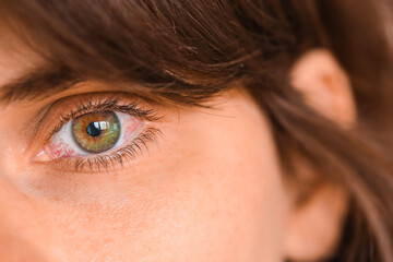 Tired eyes and contact lenses. Close up. Green eyes of a teenager inflamed and with red veins
