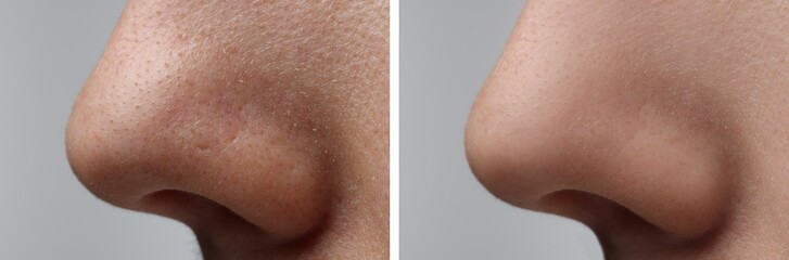 Before and after acne treatment. Photos of woman on grey background, closeup. Collage showing affected and healthy skin