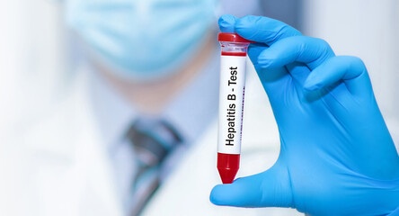 Doctor holding a test blood sample tube with hepatitis B virus (HBV) test.Banner.