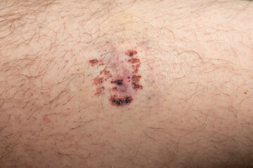 Wound from dog bite and scratched owner with blood on it drying up.