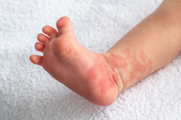 Hemangioma red birthmark on the leg of newborn baby