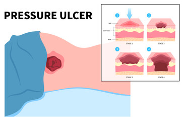Lying down or sitting prolonged period time with paralysis patient cause Bedsores pressure ulcer injury skin underlying tissue from immobility adults - obrazy, fototapety, plakaty