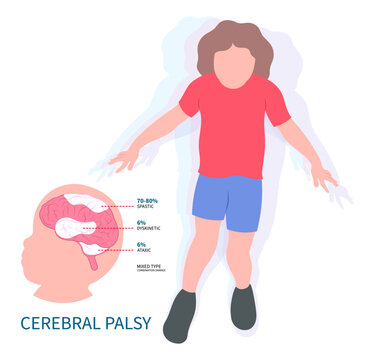 Hemiplegia Child tremors arm leg in Monoplegia Cerebral palsy dyskinetic or diplegia quadriplegia Triplegia of Parkinson's and bell's body Fetal Stiff damage birth motor Gene physical Infant head