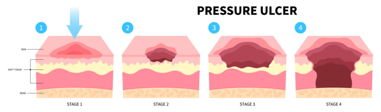 Bedsores pressure ulcer injury skin underlying tissue from lying down or sitting prolonged period time with paralysis patient and immobility adults