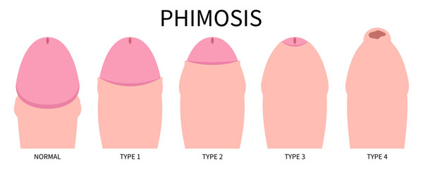 Herpes simplex the HSV or HPV virus cause phimosis swelling pain medical anatomy of circumcision paraphimosis with Redness itchy prepuce Genital candidiasis yeast bacteria preputial adhesion