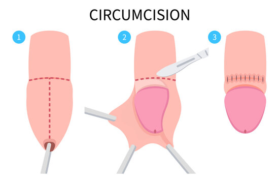 Medical anatomy of Circumcision paraphimosis for phimosis swelling pain with HSV and HPV or Herpes simplex virus Redness itchy prepuce Genital candidiasis yeast bacteria preputial adhesion