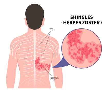 Shingles Herpes Zoster virus on body and skin itching rash blister sores of varicella chickenpox pain torso Vaccine