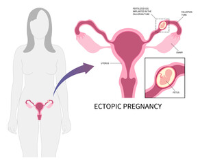 Medical anatomy for IVF or In vitro Fertilisation in the miscarriage with blocked fallopian tube of Ectopic pregnancy abortion or blighted ovum and ovaries womb by fertilized