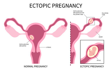 miscarriage with blocked fallopian tube of Ectopic pregnancy abortion or blighted ovum and In vitro Fertilisation ovaries womb by fertilized
