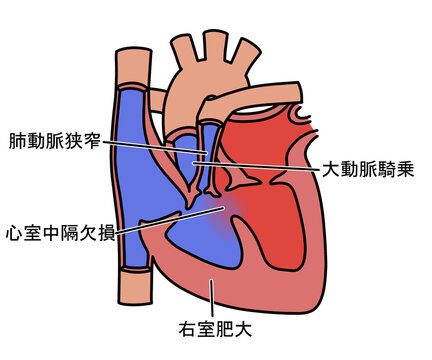 ファロー四徴症