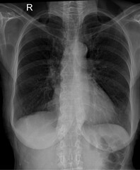 X-Ray Image Of Human Chest for a medical diagnosis