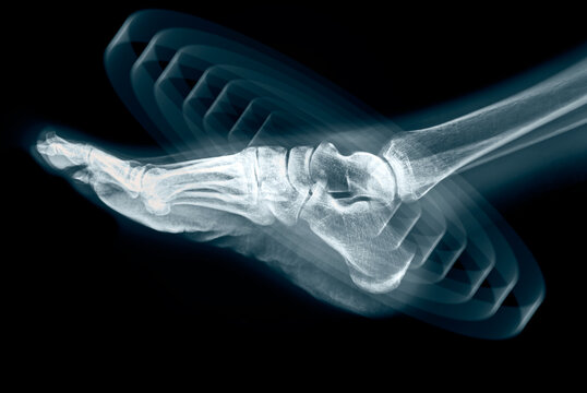 Foot pain on x-ray on black background