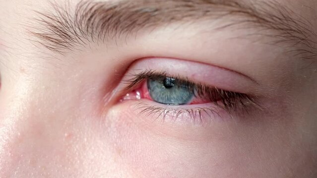 Irritated red blood eye full with capillar net. Conjunctivitis after flu, cold or allergy close-up