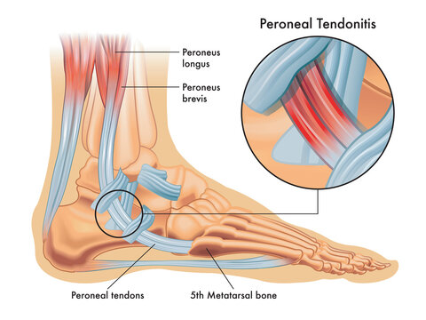 Medical illustrations of symptoms of peroneal tendonitis, with enlargement of the affected area, with annotations.