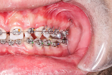 Dental orthodontic braces with colored spots. Teeth alignment treatment of diastema and crooked teeth. Half side mouth arches biting occlusion. Macrophotography close-up with shallow depth of field.