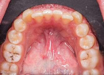 Dentistry case with crooked anterior teeth and molar caries. Lip retracted with black contraster, lower mandibular arch directly above occlusal view with tongue retracted, lingual frenulum and saliva. - obrazy, fototapety, plakaty