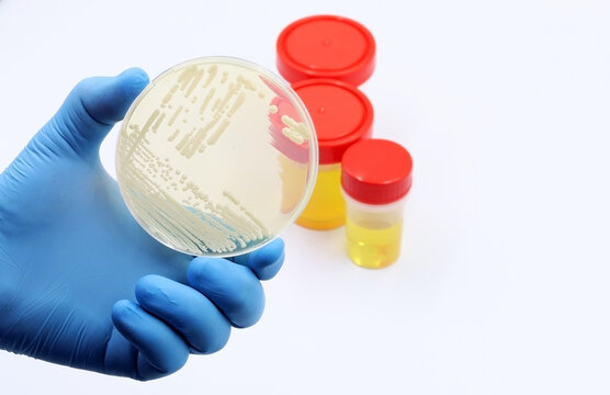 Hand of doctor or scientist showing a microbiological culture of the yeast Candida auris, responsible for urinary tract infections (UTIs)