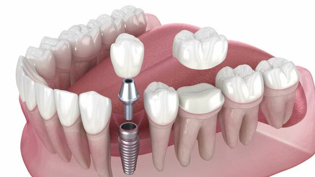 Dental implant and crown placement. Dental 3D animation