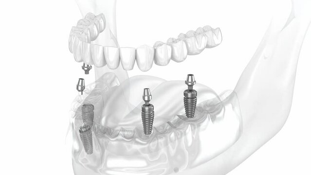 Mandibular prosthesis all on 4 system supported by implants. Dental 3D animation