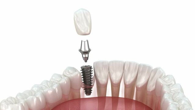 Dental implant installation and crown placement. 3d animation