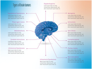 Types of brain tumors according to the affected area.illustration of a brain with points marked according to the tumor on a white and colored background. - obrazy, fototapety, plakaty