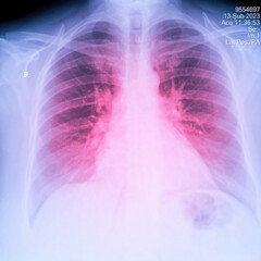 X-Ray Image Of Human Chest for a medical diagnosis, shows pain area with red. Thorax x-ray for...