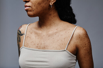 Closeup detail of black young woman with real skin texture and acne scars, copy space