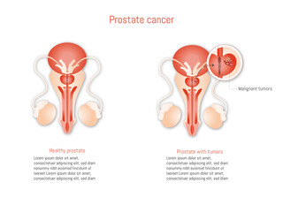 Prostate cancer infographic on white background illustration. Anatomy of male reproductive organs. Healthy prostate and cancer. 