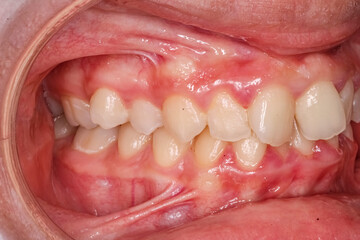 Dental maxillary and mandibular arches in occlusion with biting crooked teeth, anterior diastema...