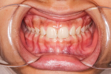 Frontal view of dental maxillary and mandibular arches in occlusion with anterior excessive...