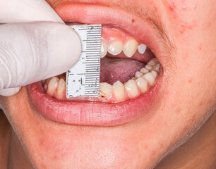 A dentist calculating the deep bite length of a patient marked with a pencil on the lower tooth and...