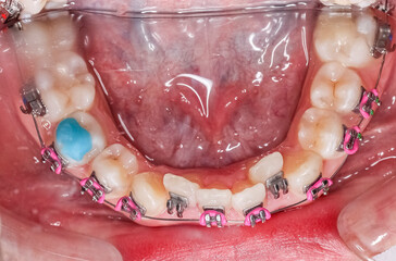 Occlusal of dental arches in occlusion with deep overbite biting teeth, bite-raising blue resin on...
