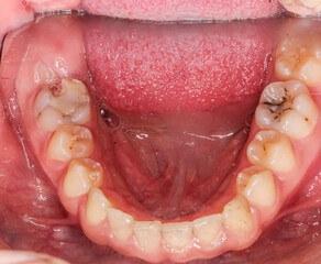 Dentistry case with unstraightened healthy teeth and no decay. Cheeks and lips retracted with cheek...